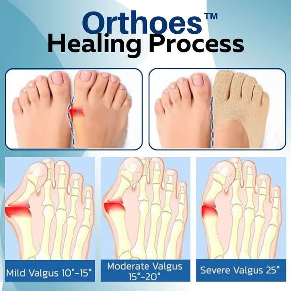 ✨ Say Goodbye to Bunion Pain! ✨ Orthoes™ Socks Correct Toes & Relieve Discomfort—Limited Time Offer!